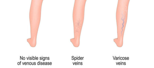 Varicose-veins-Spider-veins