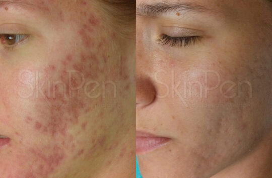 Acne Scarring x6 treatments --wm