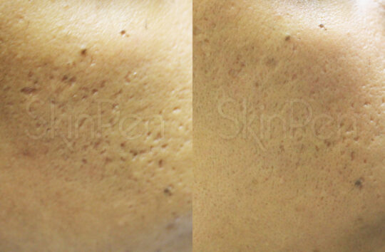 Icepick Scarring x5 treatments-wm