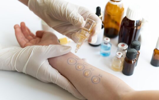 skin-allergy-reaction-test-person-s-arm