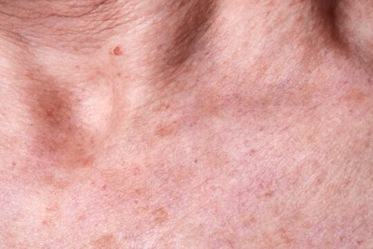 aging-female-skin-with-melasma-spots-2023-11-27-04-58-42-utc (1)